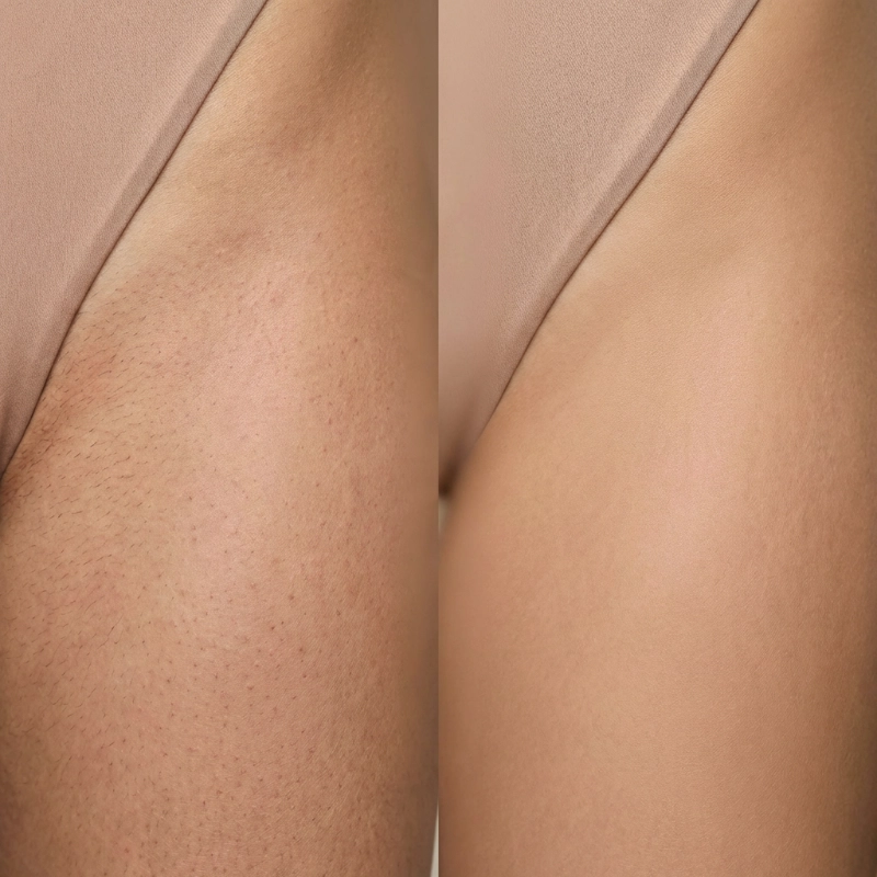 Rezultat laserske epilacije