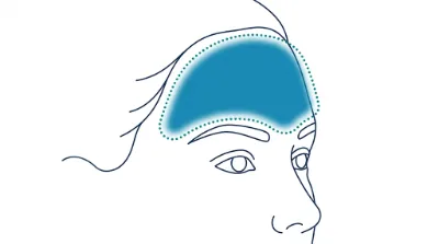 Diagram for Forehead